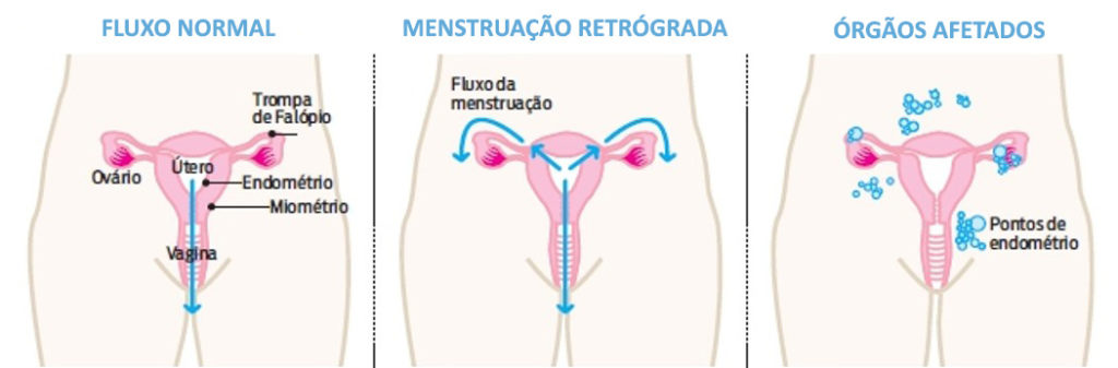 endometriose