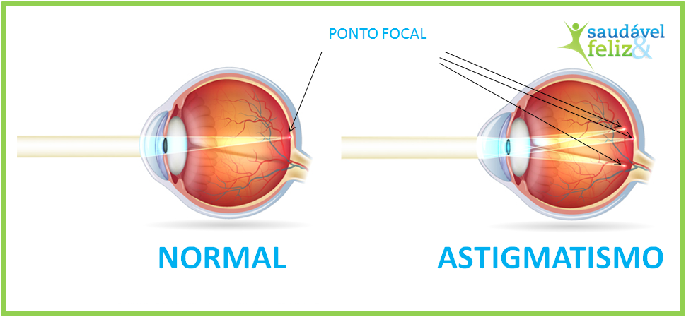 astigmatismo-e-a-miopia
