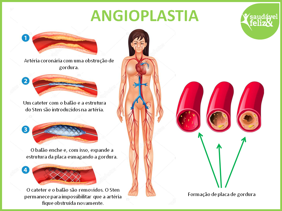 tratamento-para-angina-angioplastia 