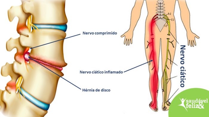 Coluna vertebral e o nervo comprimido neuralgia