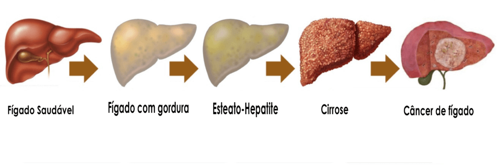 Estágios das complicações da gordura no fígado